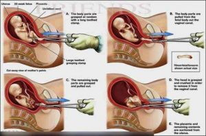 aborsi2