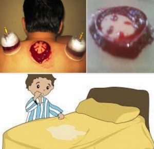ngompol